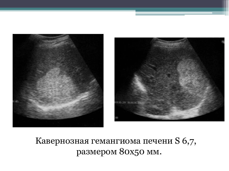 Гемангиомы в уз изображении характеризуются тест