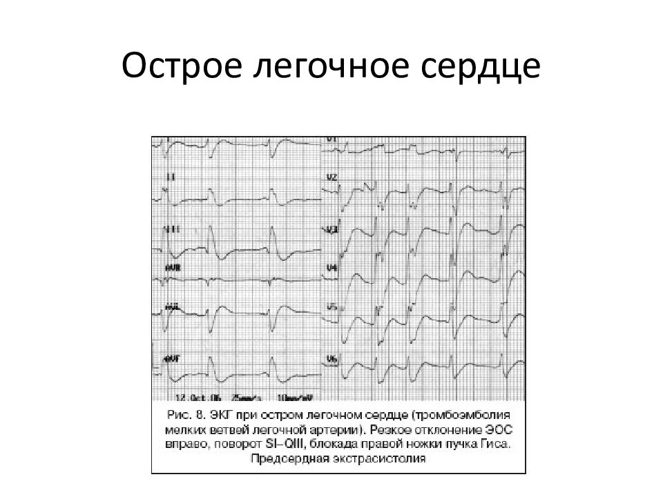 Тэла экг картина