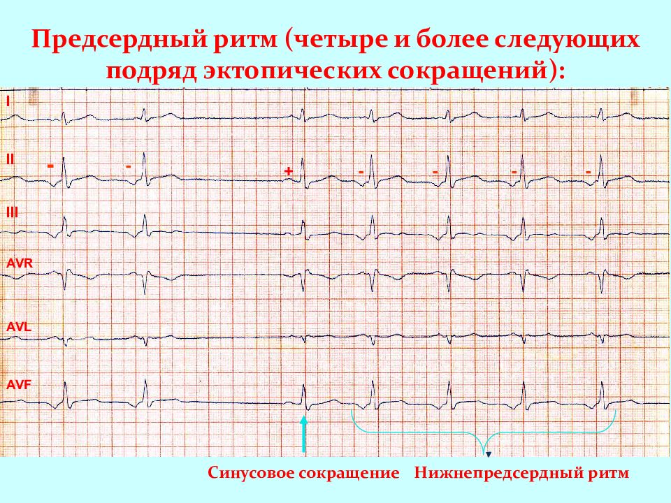 Экг при нарушениях ритма и проводимости презентация