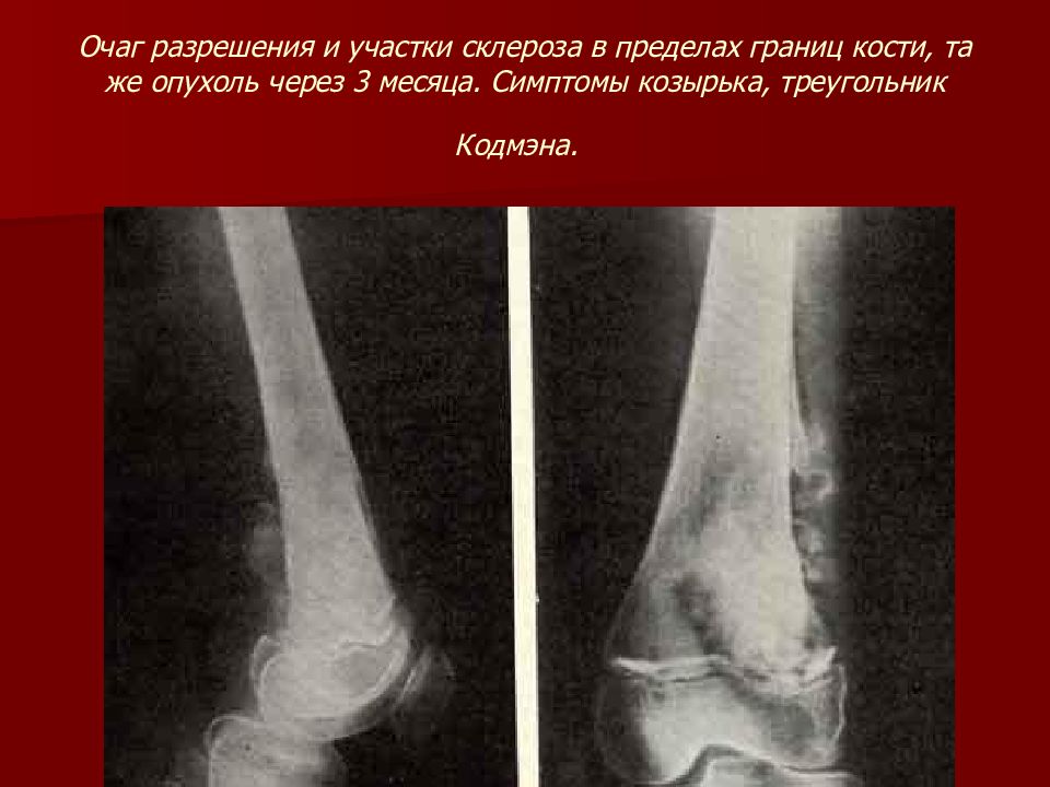 Признаки костей. Остеогенная саркома локтевой кости. Остеосаркома симптом козырька. Остеосаркома козырёк Кодмана.