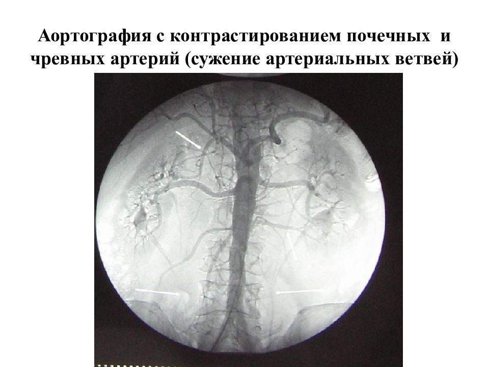 Аортография. Абдоминальная аортография. Транслюмбальная аортография.