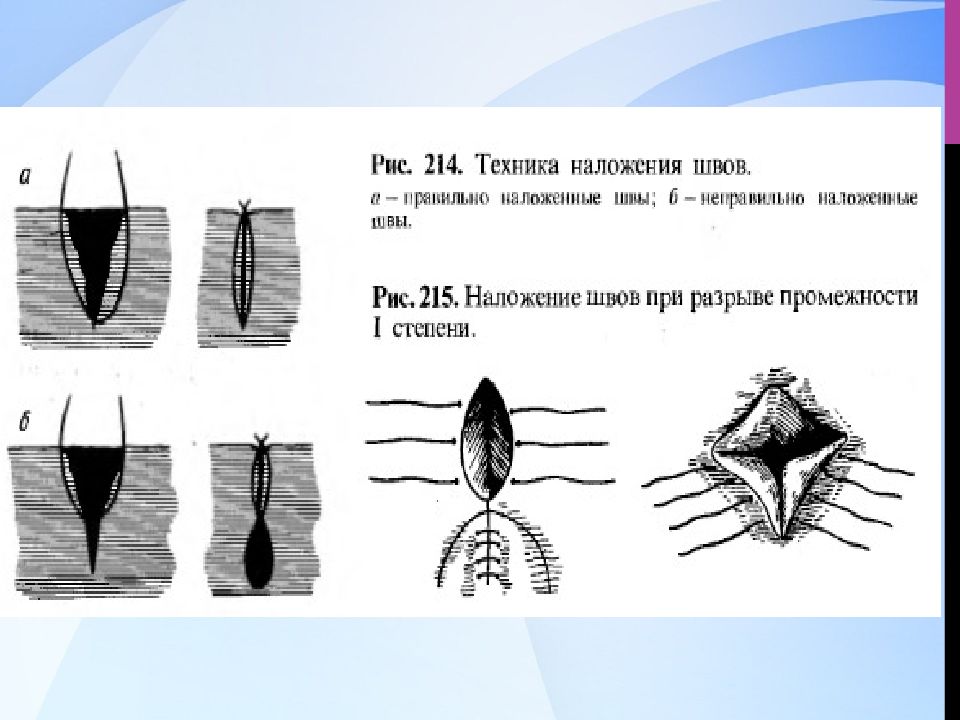 Как выглядит шов после родов при разрывах