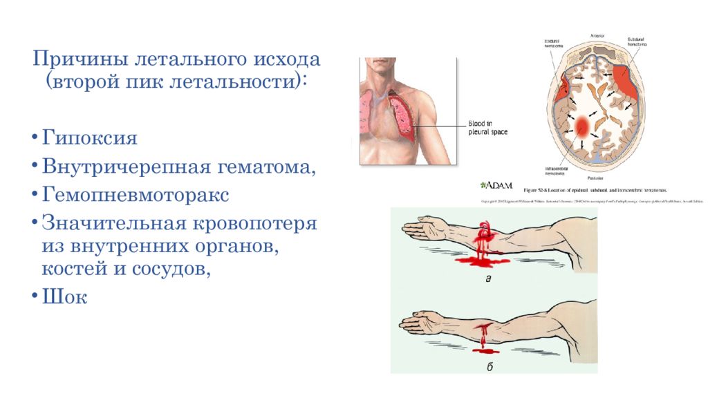 Летальный исход это. Летальная кровопотеря. Значительные кровопотери. Причины летальных исходов. Потеря крови летальный исход.