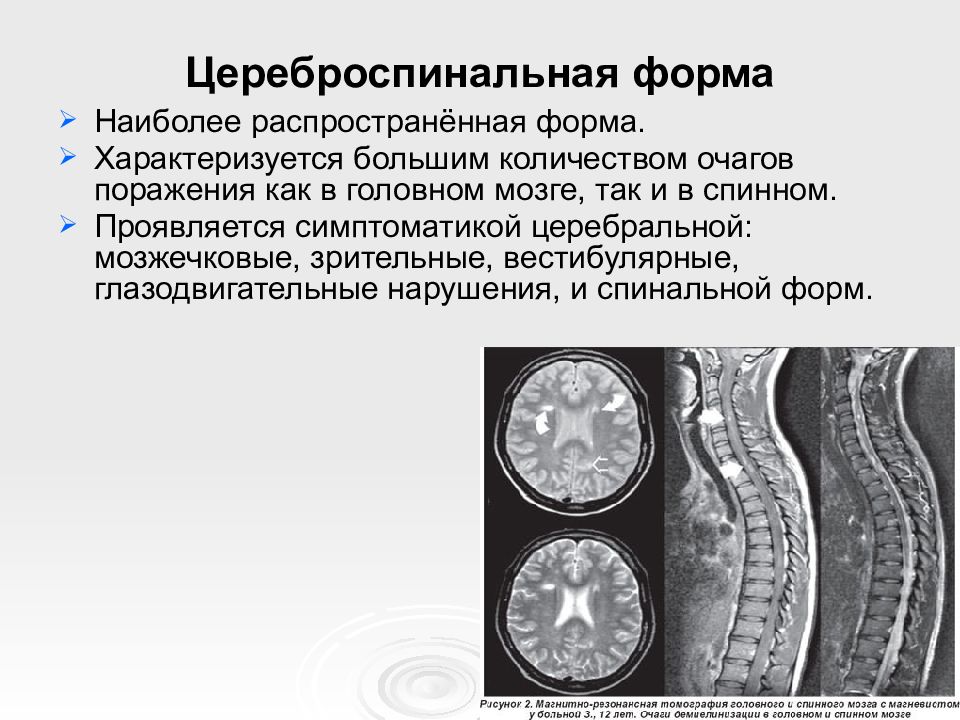 Презентация атрофия и склероз