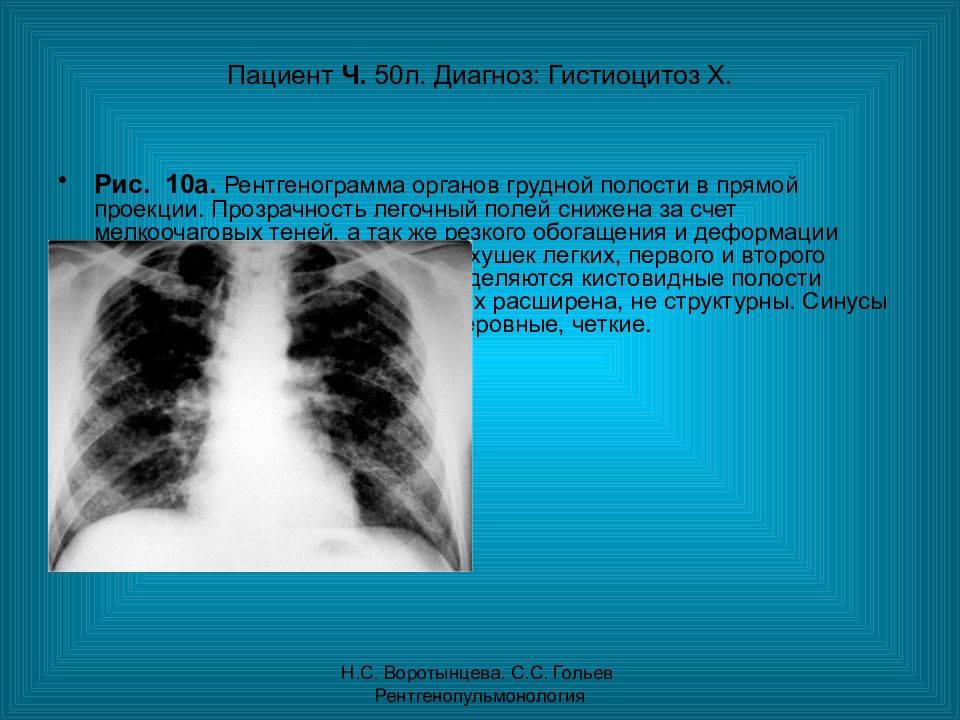 Л диагноз. Рентгенограмма органов грудной полости в прямой проекции. Гистиоцитоз легких рентген. Легочный гистиоцитоз.