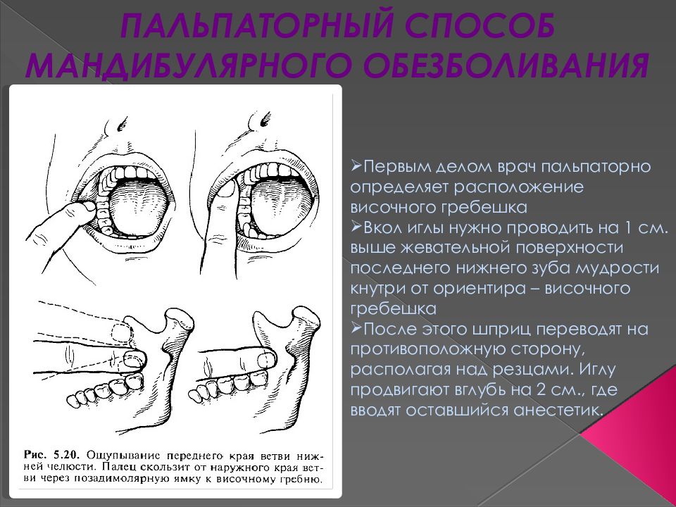 Мандибулярная анестезия презентация