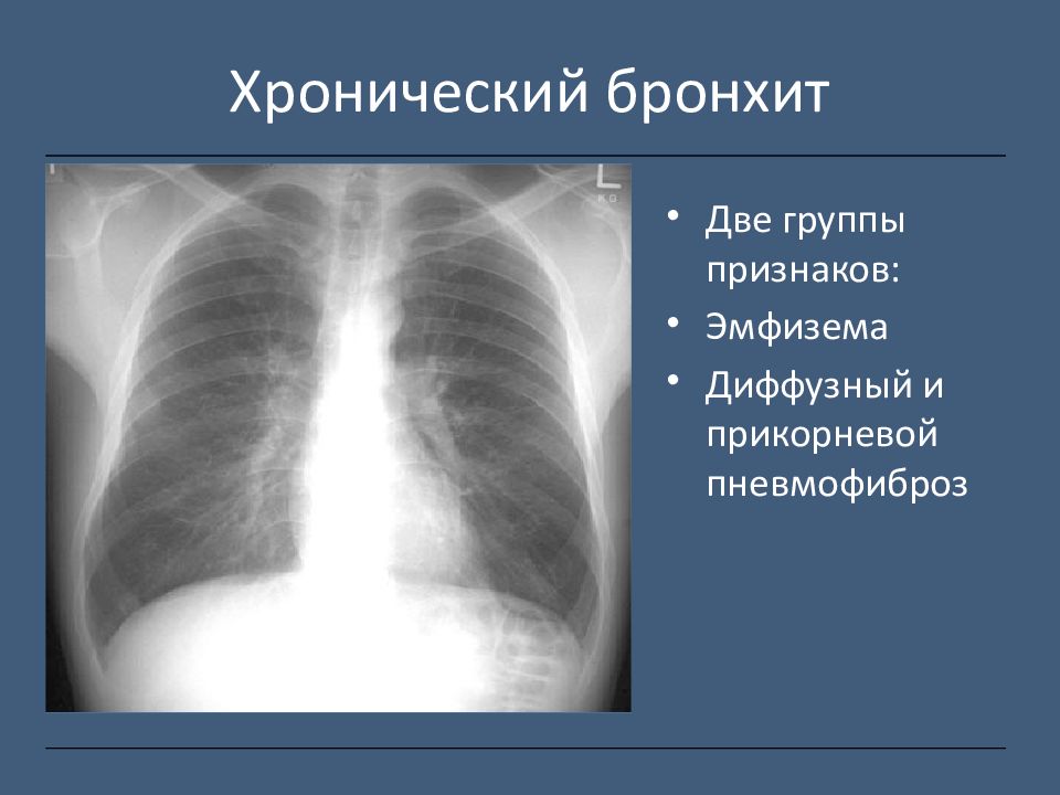 Лучевая диагностика хобл презентация