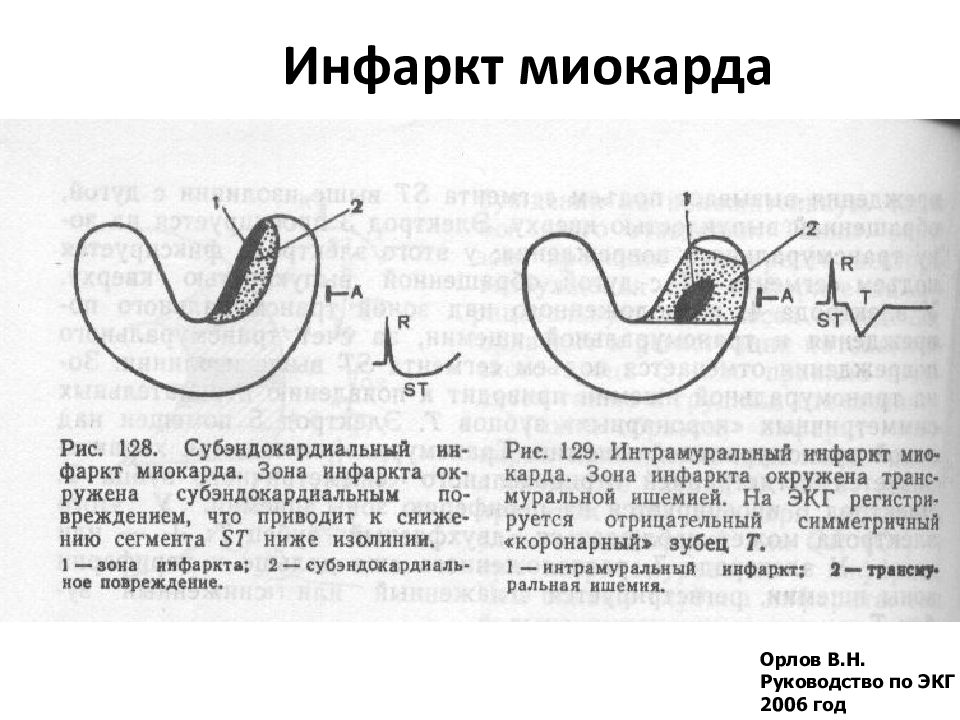 Субэндокардиальная ишемия передней стенки что это