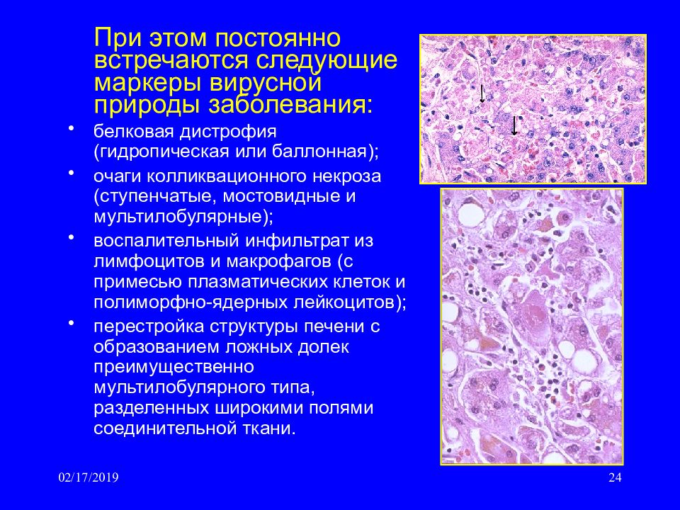 Гидропическая дистрофия. Гидропическая (баллонная дистрофия) печени. Гидропическая белковая дистрофия. Гидропическая дистрофия печени характерна для:. Гидропическая дистрофия печени микропрепарат.