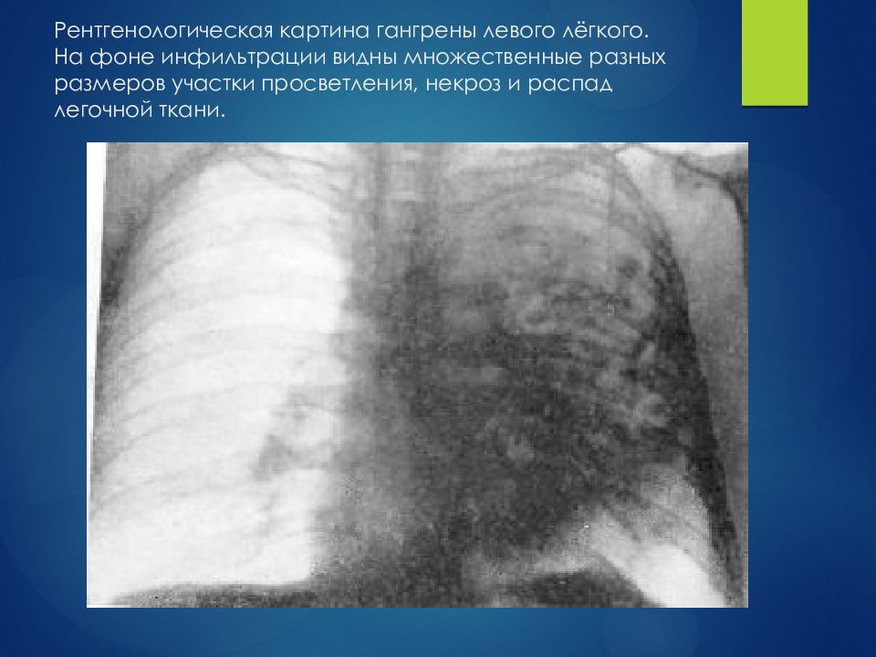 Гангрена легкого. Гангрена лёгкого рентгенограмма. Лобарная гангрена легкого. Гангрена легкого рентгенологическая картина. Рентгенография гангрены легкого.