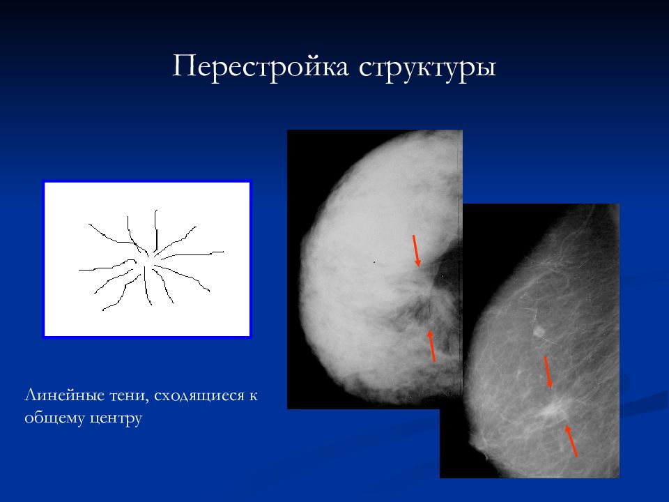 Лучевая диагностика заболеваний молочных желез. Лучевая диагностика заболеваний молочной железы. Рентгенодиагностика молочных желез. Рентгенодиагностика заболеваний молочной железы. Перестройка структуры молочной железы.