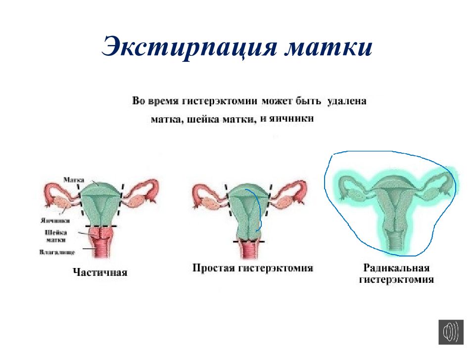 Экстирпация