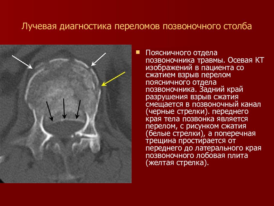 Лучевая диагностика это. Рентгенодиагностика переломов. Лучевая диагностика переломов. Методы диагностики переломов. Основы рентгенодиагностики переломов.