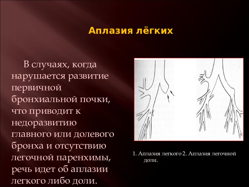 Либо легкое. Врожденные пороки развития трахеи. Врожденные аномалии трахеи и бронхов.