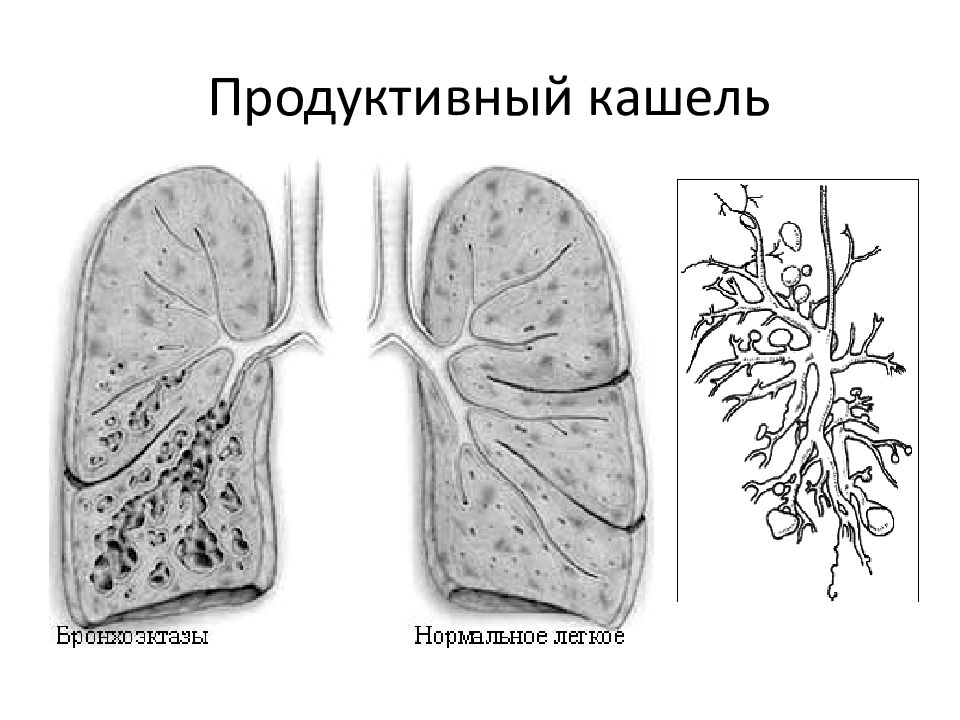 Продуктивный кашель. Продуктивный и непродуктивный кашель что это. Что такое продуктивный кашель и непродуктивный кашель. Кашель (продуктивный и непродуктивный). Классификация.