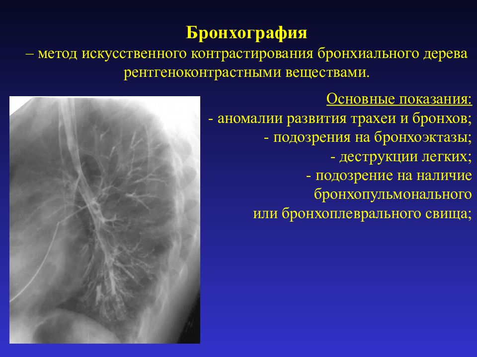 Бронхография. Бронхография патология. Контрастная рентгенография бронхов. Пороки развития трахеи и бронхов. Бронхография это метод.