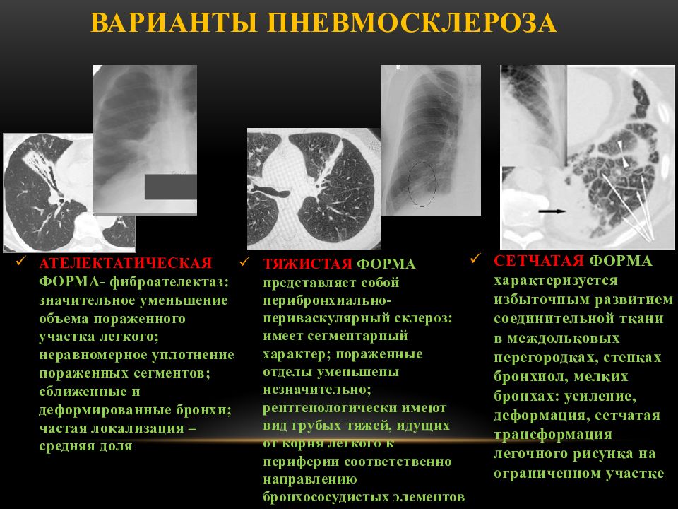 Фиброз ковид. Пневмосклероз рентген описание. Постпневмонический фиброз на кт. Постпневмонический пневмосклероз. Диффузный сетчатый пневмосклероз.