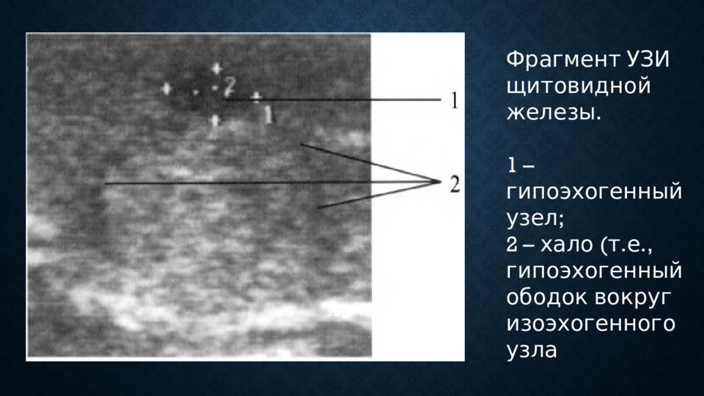 Изоэхогенное образование с четкими ровными контурами