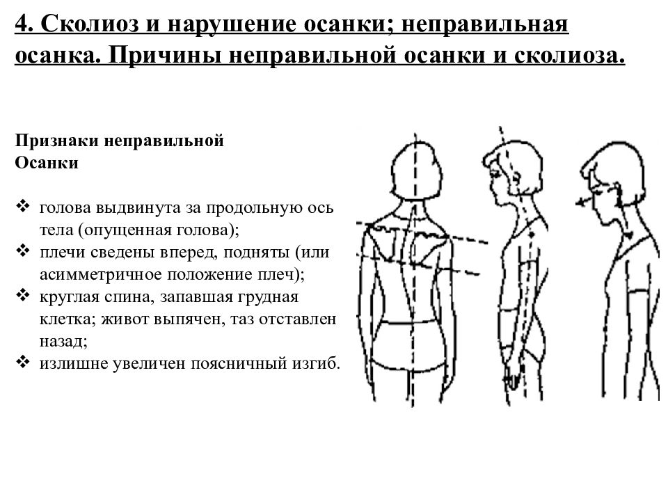 Положение плеч. Сколиотическая осанка. Признаки неправильной осанки. Асимметричное положение плеч.