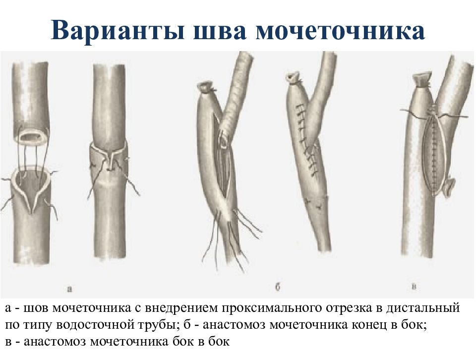 Травмы мочеточника презентация