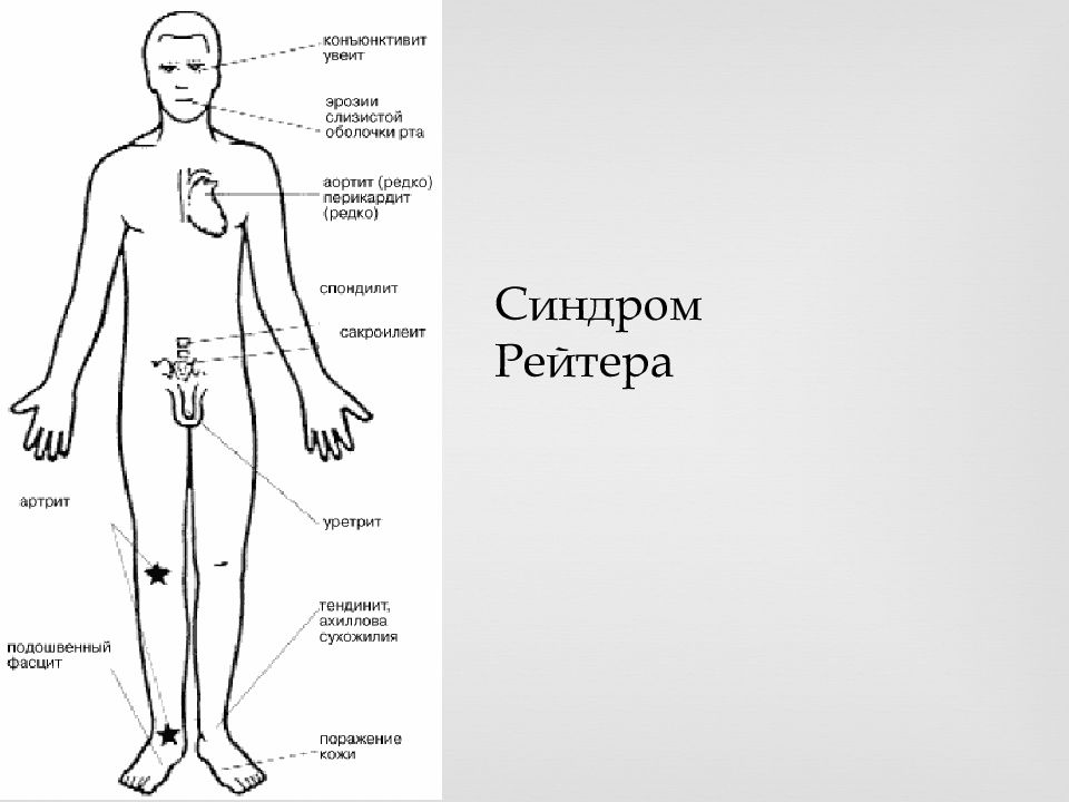 Клиническая картина синдром рейтера