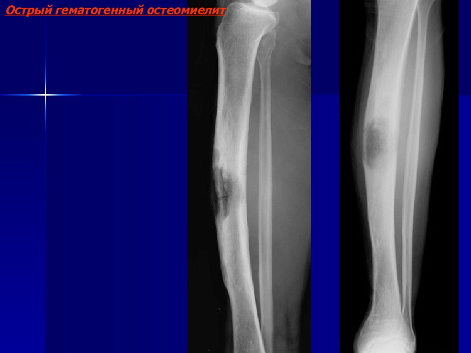 Остеомиелит рентген. Остеомиелит большеберцовой кости рентген. Гематогенный остеомиелит рентгенография.