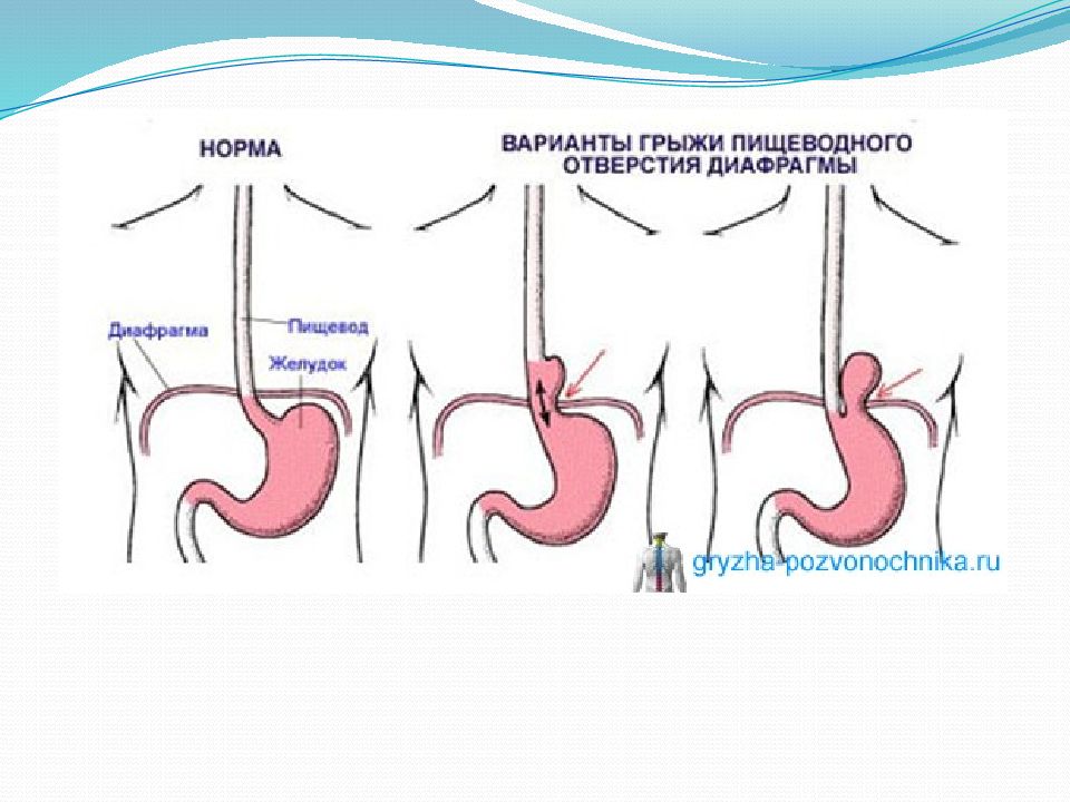 Диафрагмальная грыжа. Френоперикардиальная диафрагмальная грыжа. Парастернальная грыжа диафрагмы. Диафрагмальные грыжи схема. Грыжа пищеводного отверстия диафрагмы клиника.