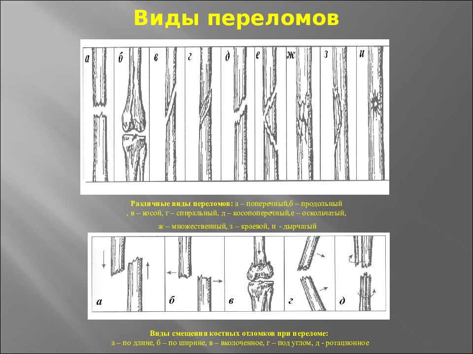 Виды переломов. Классификация переломов по направлению линии перелома. Виды переломов поперечный косой продольный винтообразный. Классификация переломов оскольчатый. Классификация переломов по линии излома.