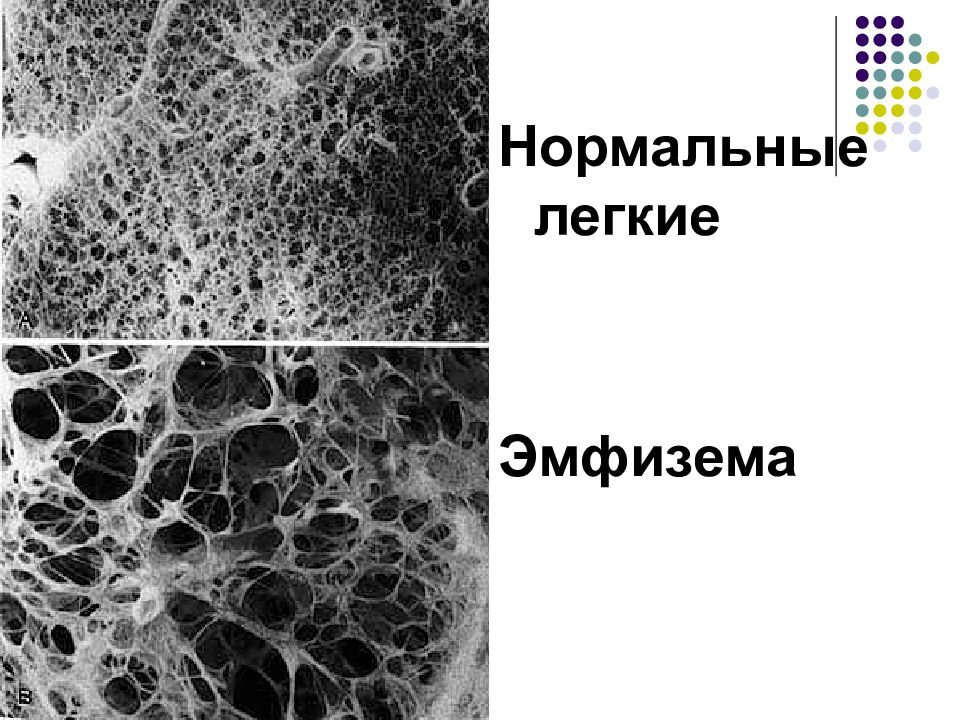 Эмфизема легких картинки