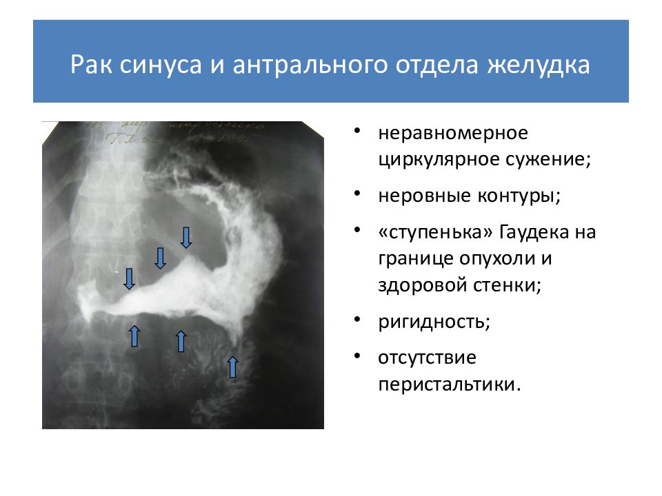 Рак жкт презентация