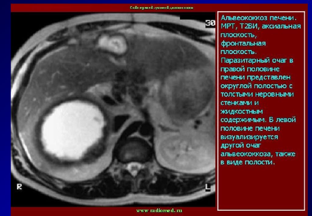 Альвеококкоз. Альвеолярный эхинококкоз печени. Альвеококкоз головного мозга. Альвеококкоз печени мрт. Альвеококкоз печени кт картина.
