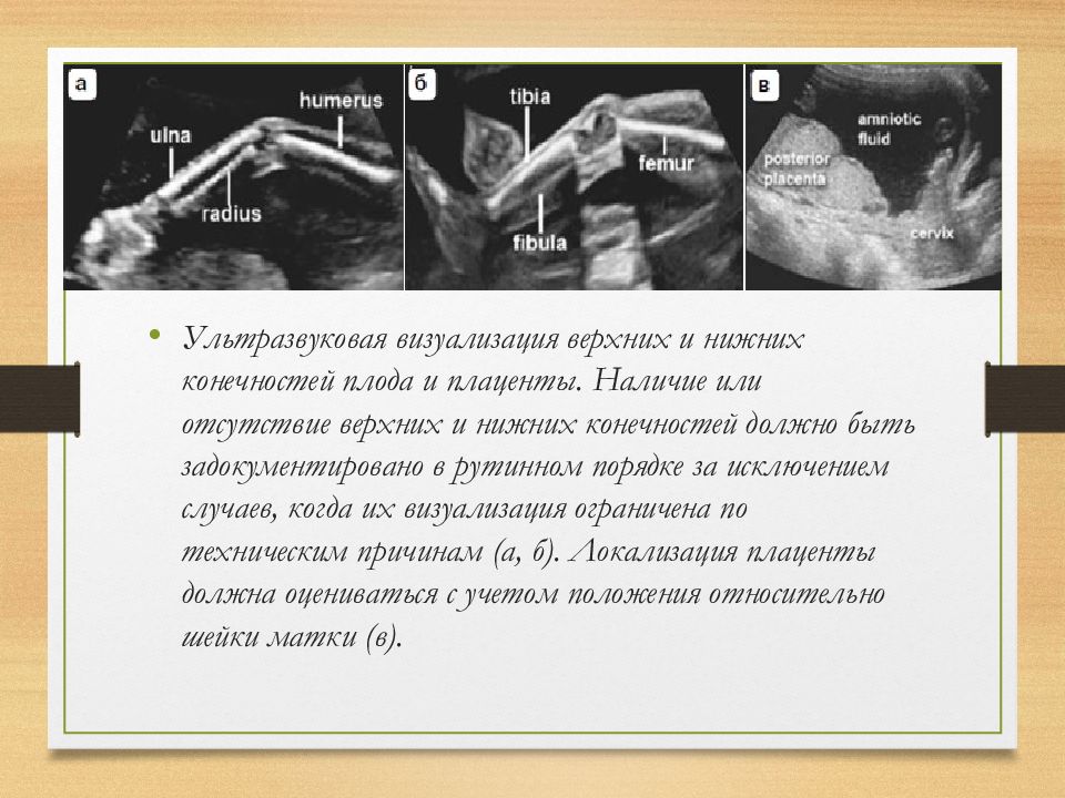 Диабетическая фетопатия презентация