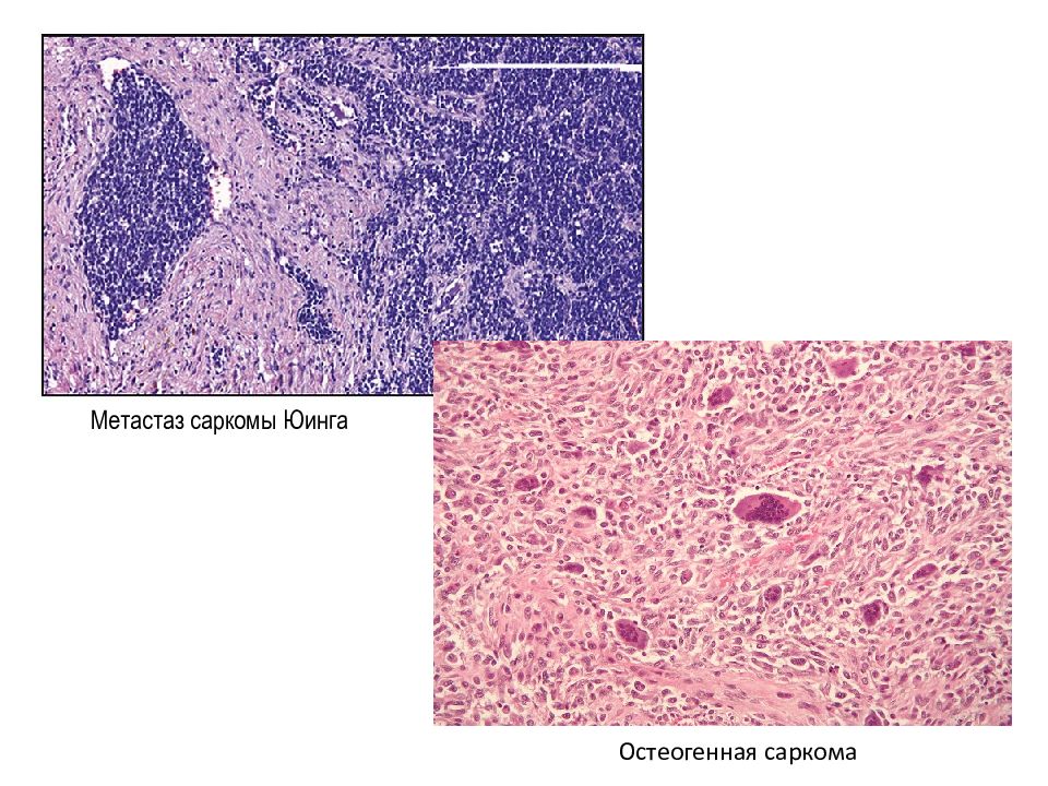 Ткань латынь. Саркома Юинга гистология. Остеогенная саркома микропрепарат. Опухоли фиброзной ткани. Остеотлная ткань.