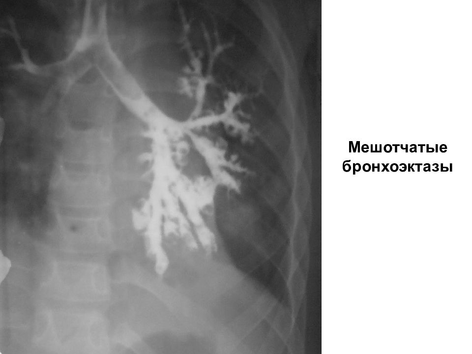 Бронхоэктазы. Мешотчатые бронхоэктазы легких. Мешотчатые бронхоэктазы кт. Цилиндрические и мешотчатые бронхоэктазы. Цилиндрические бронхоэктазы.