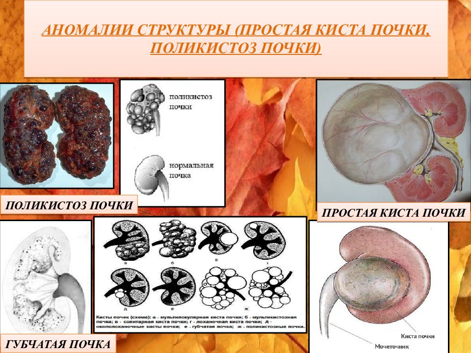 Типы кисты почек. Аномалии структуры почек. Поликистоз почки почки. Аномалии структур почек классификация.