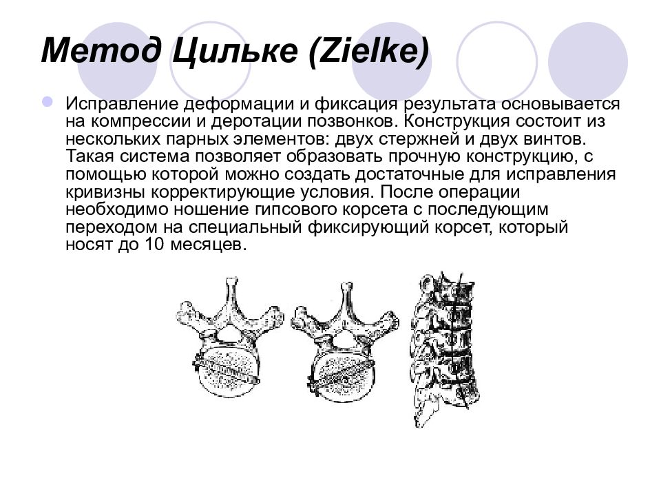 Хирургическое лечение сколиоза презентация