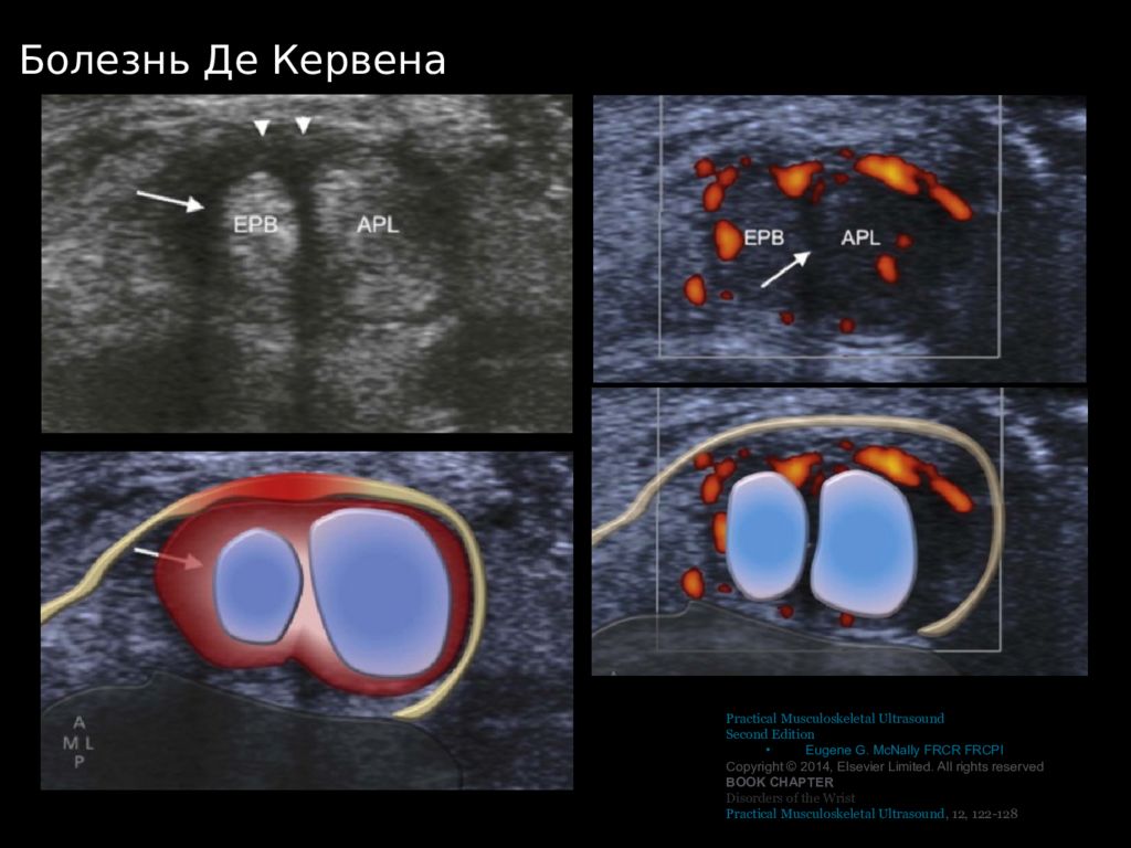 Болезнь кервена. Теносиновит де Кервена на УЗИ. Болезнь де Кервена УЗИ. Синдром де Кервена УЗИ заключение.