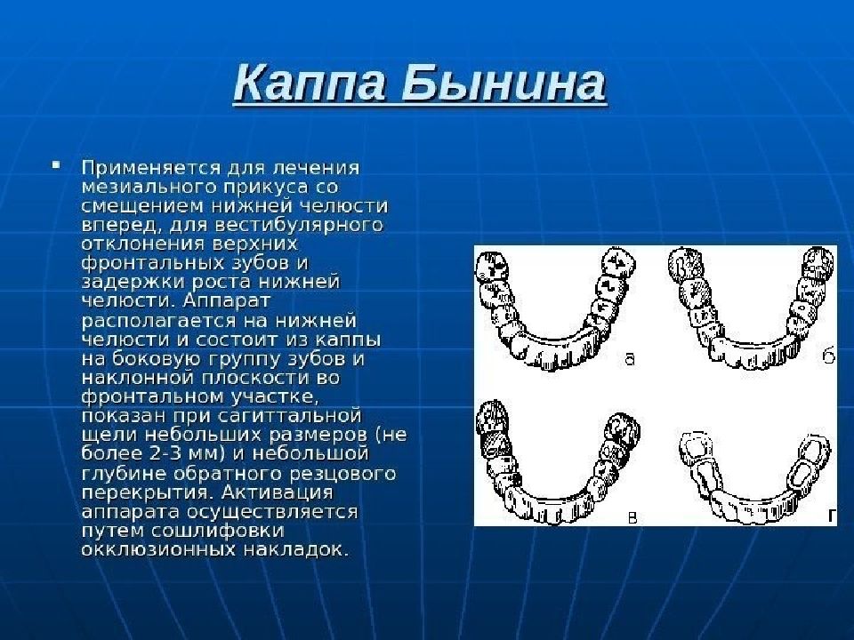 Лечение мезиальной окклюзии. Аппарат Бынина Каппа. Каппы Шварца и каппы Бынина. Каппа Бынина и Шварца ортодонтия. Каппа Бынина ортодонтия.