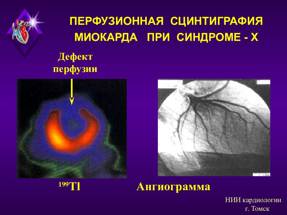 Презентация сцинтиграфия миокарда