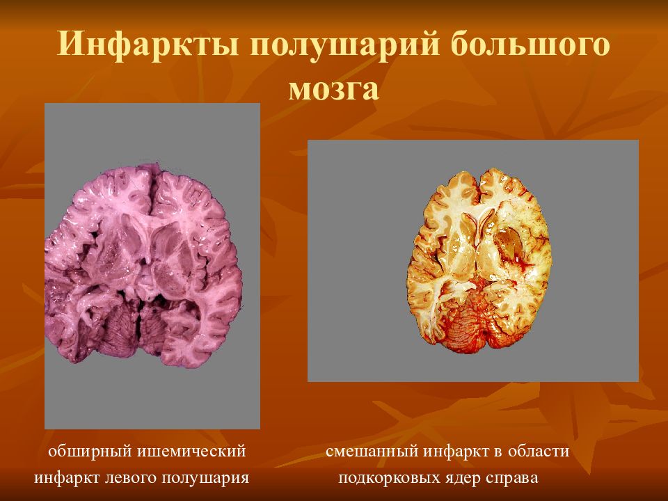 Левое полушарие мозга инсульт. Ишемический инфаркт головного мозга. Смешанный инфаркт мозга. Ишемический инсульт (инфаркт мозга). Инфаркт левого полушария головного мозга.