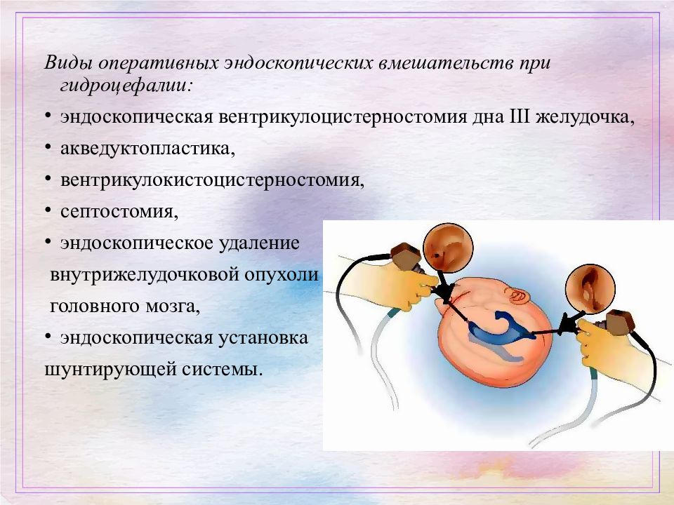 Виды гидроцефалии. Эндоскопические операции при гидроцефалии. Эндоскопия головного мозга при гидроцефалии. Эндоскопическая вентрикулоцистерностомия дна третьего желудочка. Эндоскопическая операция при гидроцефалии головного мозга у ребенка.