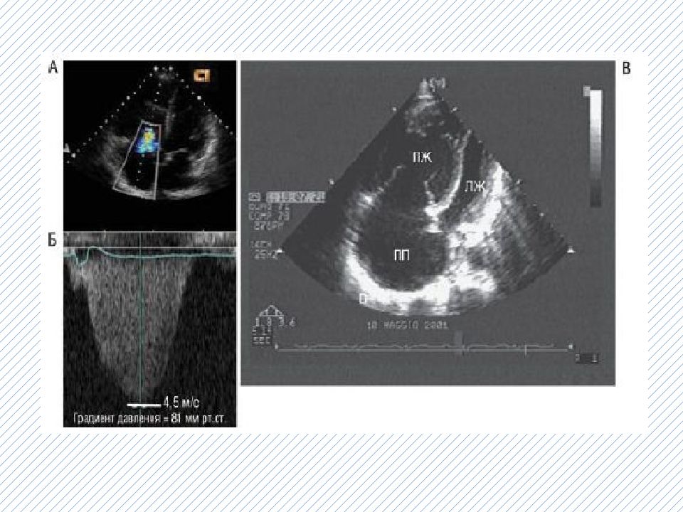 легочная гипертензия эхо
