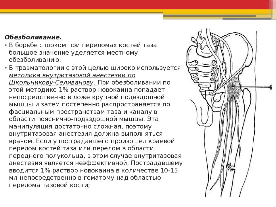 Переломы конечностей таза