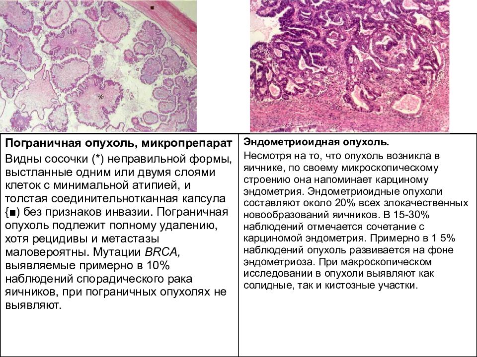 Эпителиальные опухоли. Трубная беременность микропрепарат патанатомия. Пограничная опухоль яичника гистология. Патологическая анатомия Трубная беременность микропрепарат. Трубная беременность макропрепарат.