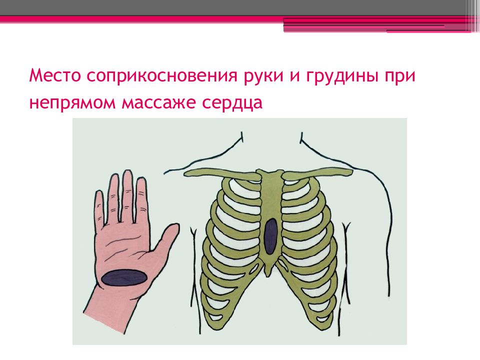 Давление на грудину. Расположение рук при непрямом массаже сердца. Место соприкосновения руки и грудины при непрямом массаже сердца. Место расположения ладоней при непрямом массаже сердца. Правильное положение рук при непрямом массаже.