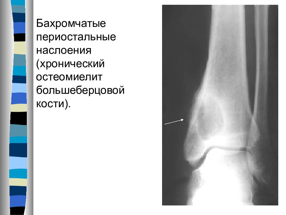 Остеомиелит рентген. Хронический остеомиелит коленного сустава рентген. Хронический остеомиелит рентген схема. Хронический гематогенный остеомиелит рентген с описанием. Рентген гематогенный остеомиелит большеберцовой кости.