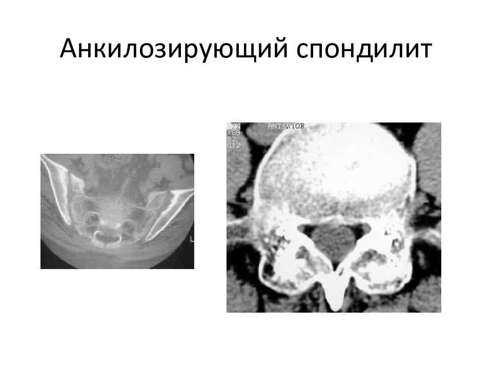 Анкилозирующий спондилит презентация