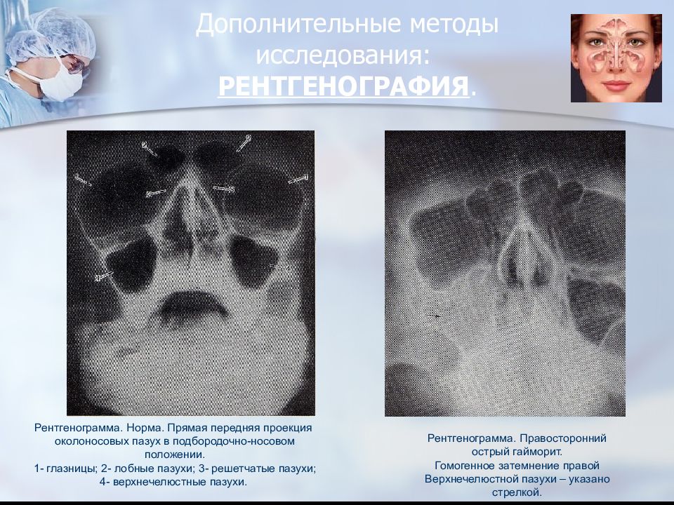 Лучевая картина при синуситах и кистах придаточных пазух носа