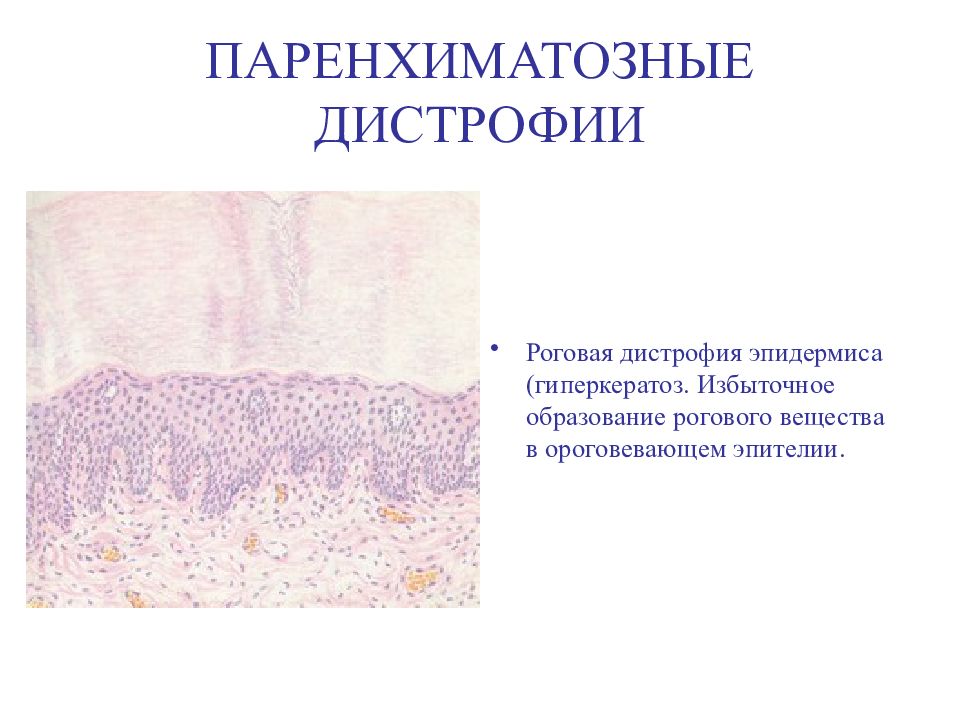 Паренхиматозные дистрофии виды. Паренхиматозные белковые дистрофии гидропическая. Роговая дистрофия эпителия кожи микропрепарат. Роговая дистрофия эпидермиса. Микроскопия Роговая белковой дистрофии.