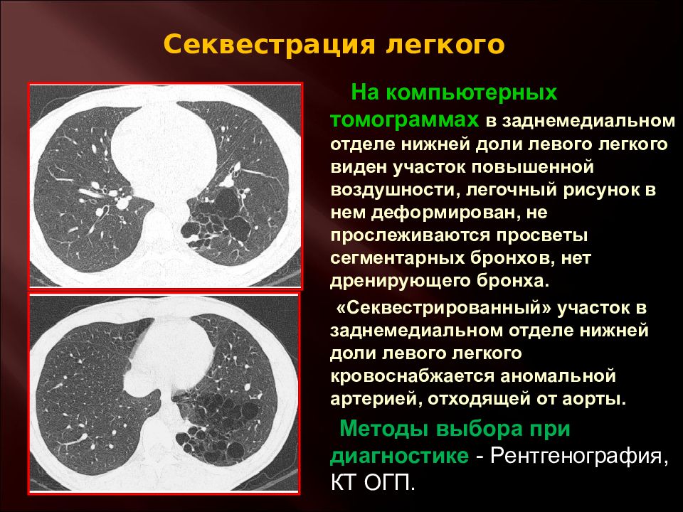 Поствоспалительные изменения в легких на кт. Секвестрация нижней доли правого легкого. Аномалии развития легких кт. Секвестрация легкого на кт.